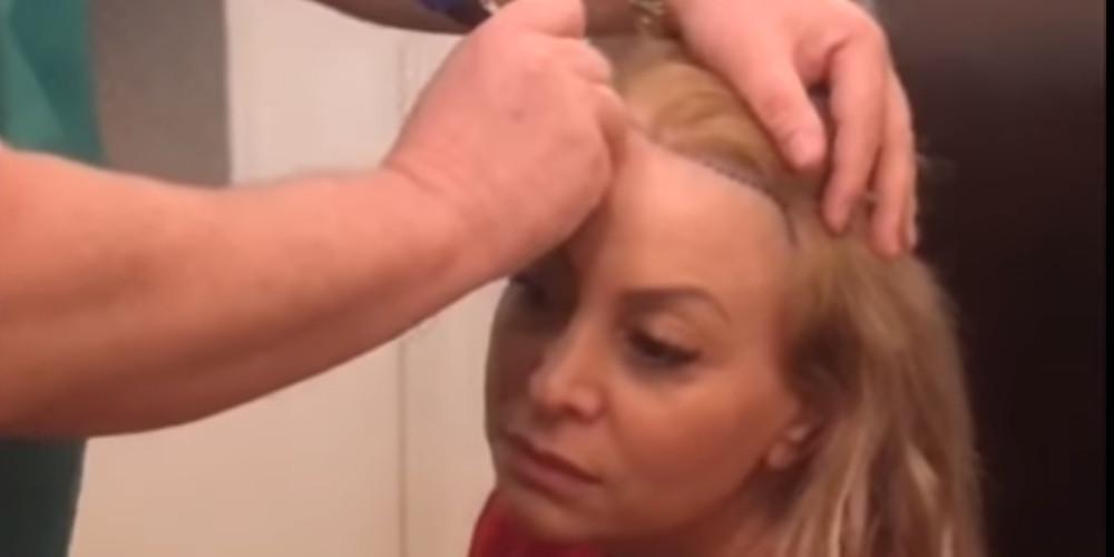 Εμφύτευση μαλλιών μπροστά στην κάμερα έκανε η Τέτα Καμπουρέλη [βίντεο]