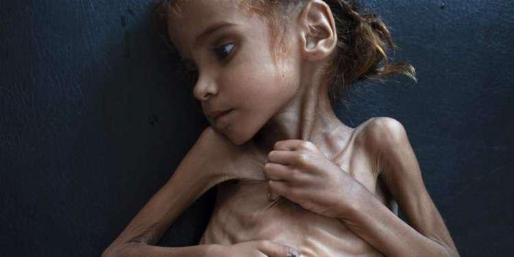 85.000 παιδιά κάτω των 5 ετών έχουν πεθάνει από υποσιτισμό στην Υεμένη σύμφωνα με την Save the Children