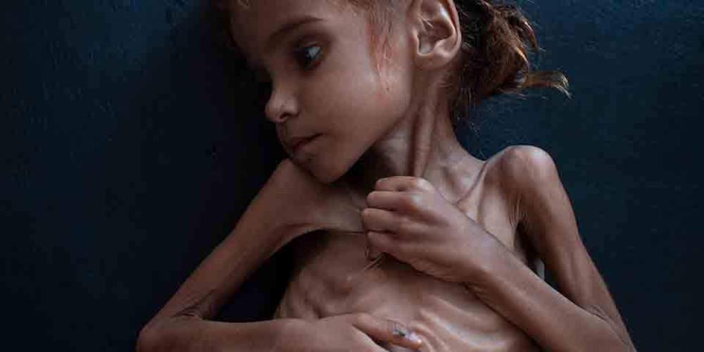 Τραγωδία: Πέθανε η 7χρονη Αμαλ - Το κορίτσι-σύμβολο του λιμού στην Υεμένη