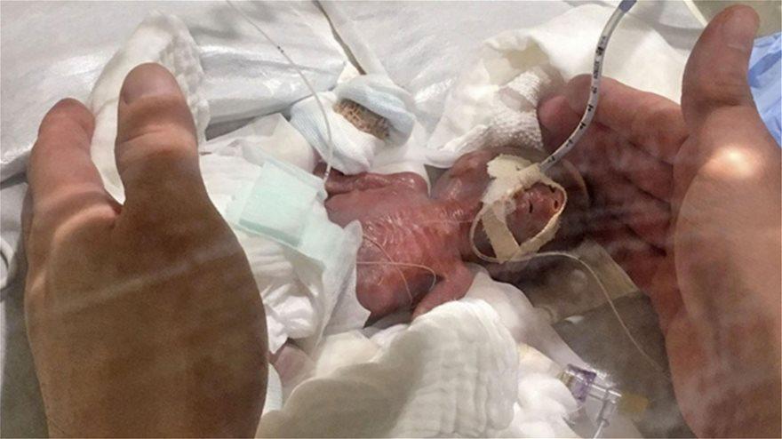 Απίστευτο: Το μικρότερο μωρό στον κόσμο από 268 γραμμάρια έφτασε τα 3,2 κιλά! [εικόνες]