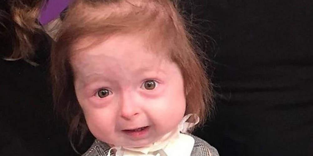 Απίστευτο: 2χρονο κοριτσάκι πάσχει από σπάνια ασθένεια που την γερνάει πρόωρα