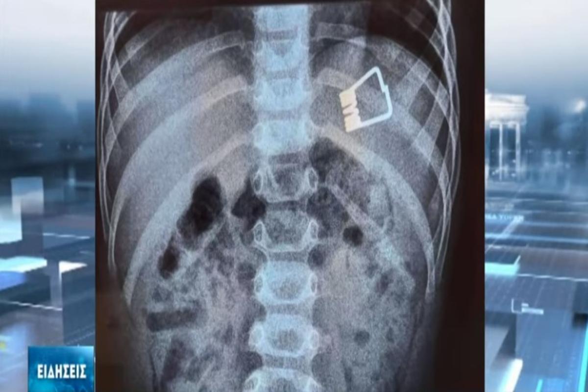 Θρίλερ στη Λήμνο: Δίχρονο αγοράκι κατάπιε μανταλάκι – Το έσωσαν χωρίς χειρουργείο οι γιατροί