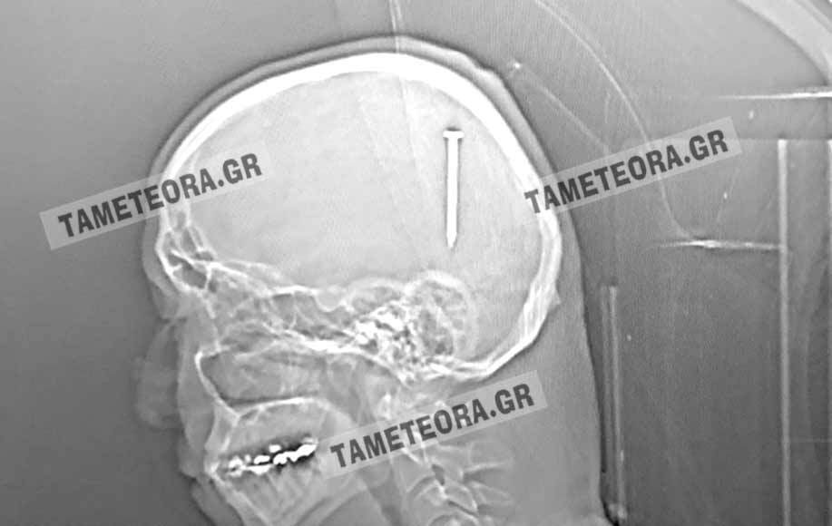 Καλαμπάκα: Του σφηνώθηκε καρφί 5 εκατοστών στο κεφάλι