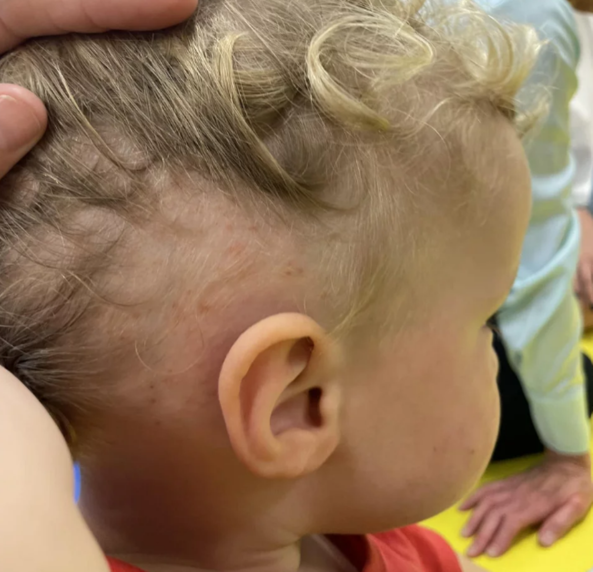 Κοριοί: Τρομακτική εμφάνιση και στη Βρετανία- Σοκάρουν τα δαγκώματα σε 2χρονο