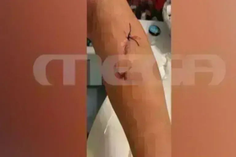Ραφήνα: Τρομοκρατημένη η γυναίκα που δέχθηκε επίθεση από σκυλιά - «Με έριξαν κάτω και άρχισαν να με δαγκώνουν» [βίντεο]